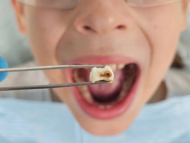 Best Emergency Dental Care for Abscessed Tooth in Sabetha, KS